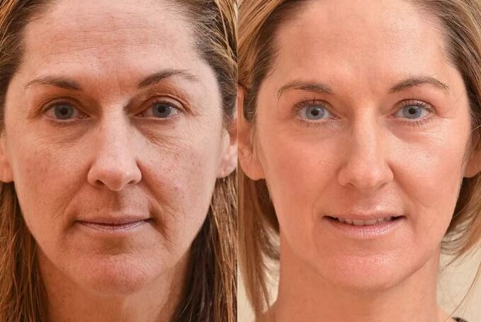 Rejuvenation of the face before and after