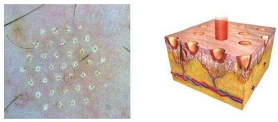 The fraction laser affects the point of the skin