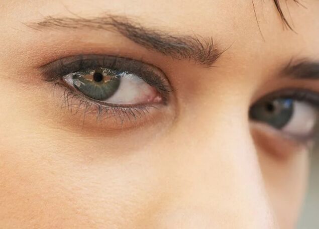 Dark circles under the eyes