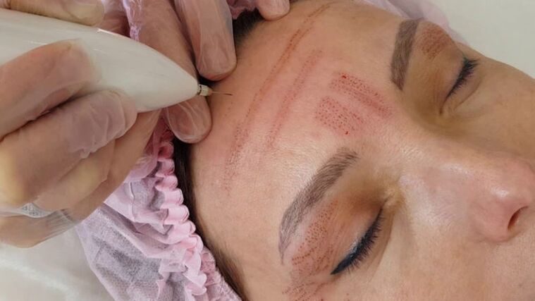 Plasma facial rejuvenation