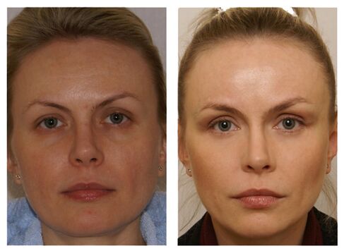 A course of injections with meso cocktails