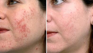 photos before and after partial skin rejuvenation
