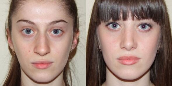 Girl before and after plasma facial skin rejuvenation